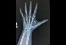 Biohacking: cómo es vivir con varios chips bajo la piel